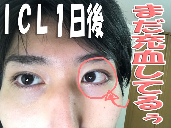 ICL1日後の眼
