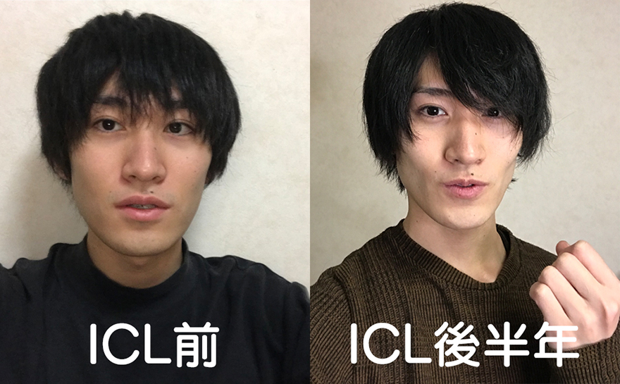 ICL前と後の体型変化