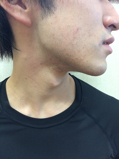 脱毛する前