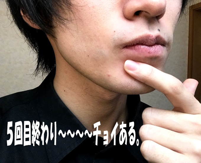 ヒゲ脱毛5回目終わり