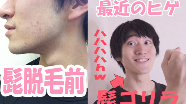 ヒゲ脱毛の経過をレビューする記事
